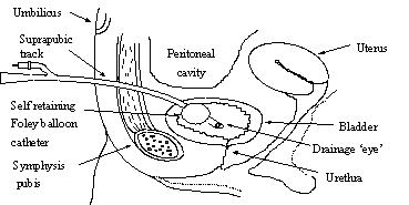 suprapubic catheter foley